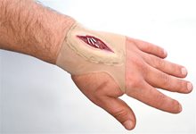 Picture of Gashed Hand Wound Sleeve